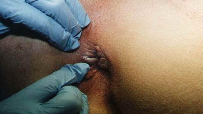 عکس دارو برای شقاق مقعد