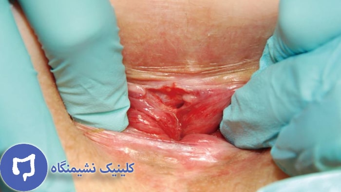 عکس آنتی فیشر برای درمان شقاق مقعدی