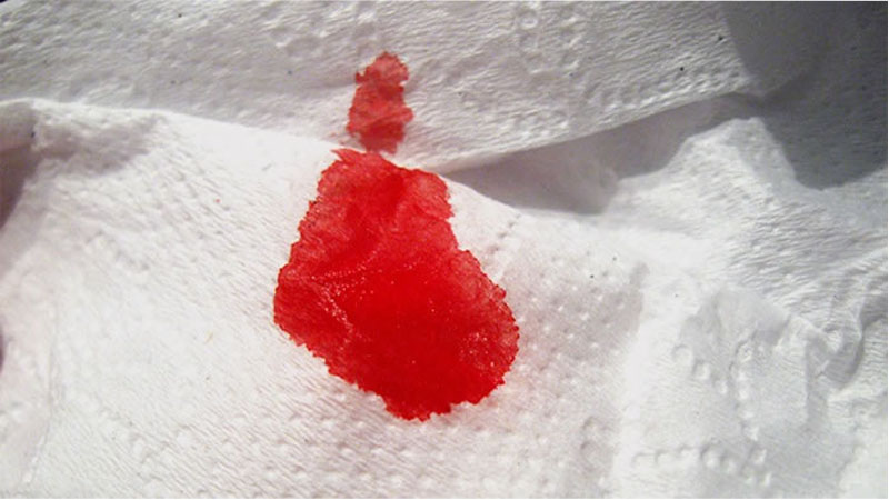 تصویر خونریزی از مقعد