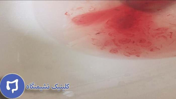 عکس آمدن خون از مقعد
