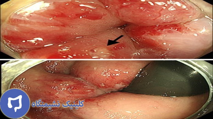 عکس بواسیر خونی
