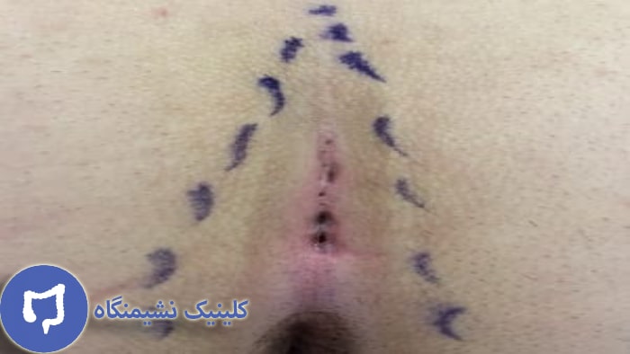 عکس کیست مویی بعد از عمل