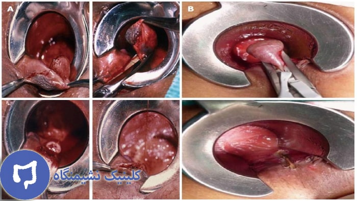 عکس درمان بواسیر در کودکان