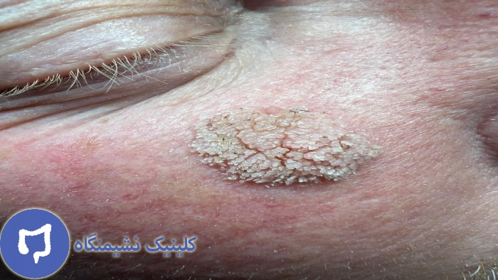 عکس زگیل صورت