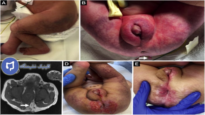 عکس بواسیر در کوردکان