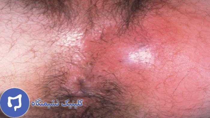 عکس آبسه مقعدی