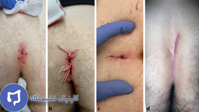 عکس عوارض کیست مویی در مردان