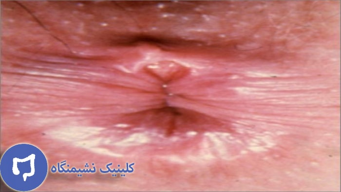 تصویر شقاق مقعدی و هزینه درمان آن