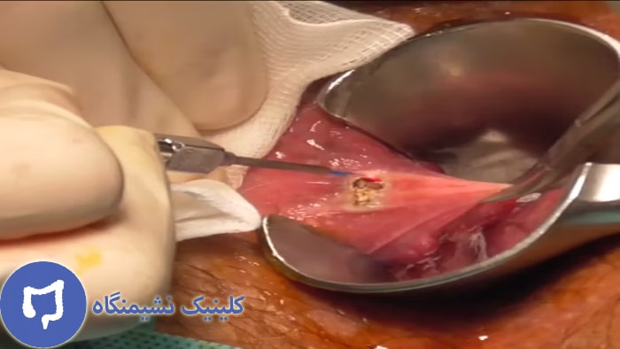 عکس هزینه درمان شقاق مقعدی با لیزر