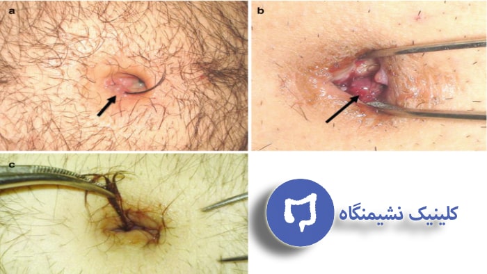 عکس خطرات کیست مویی در پائین کمر