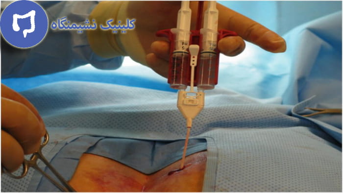 عکس تشخیص فیستول مقعدی پیشرفته