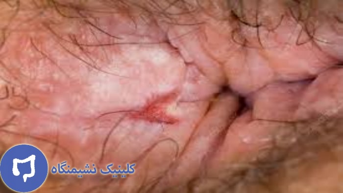 عکس درمان فیشر با رژیم غذایی