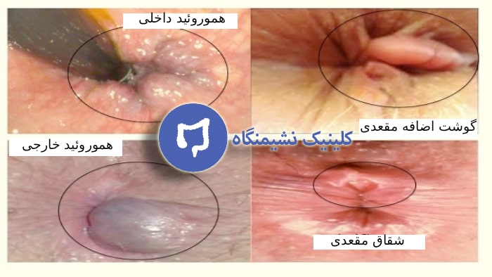 بواسیر عکس گوشت اضافه مقعدی