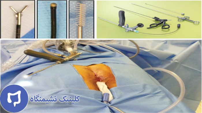 عکس درمان کیست مویی با روش آندوسکوپی سینوس پیلونیدال