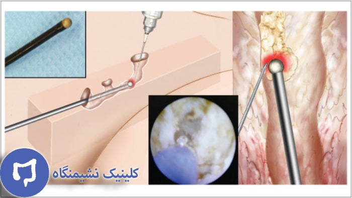 عکس عمل کیست مویی با آندوسکوپ
