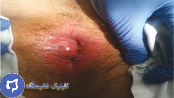 عکس هموروئید ترومبوزه