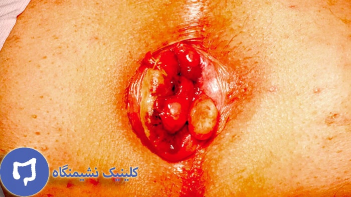 عکس بواسیر خارجی خطرناک