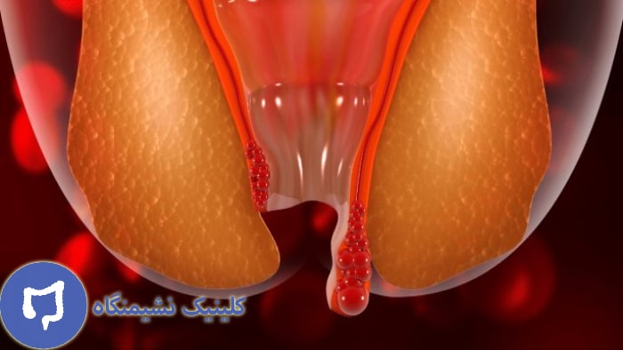 عکس شماتیک بواسیر خارجی