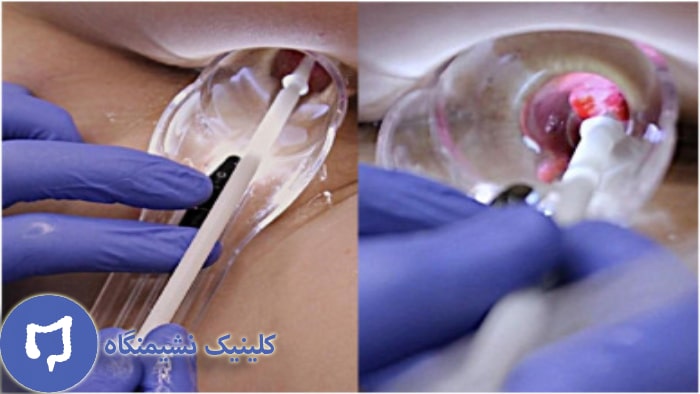 عکس درمان هموروئید خارجی با لیزر