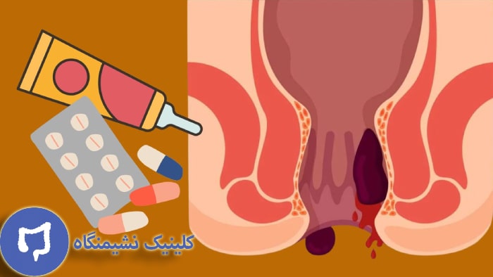 عکس درمان بواسیر خارجی با دارو