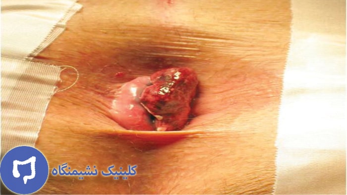 عکس بواسیر خارجی