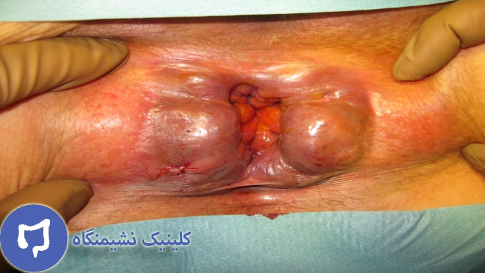 عکس بواسیر خارجی و علائم آن