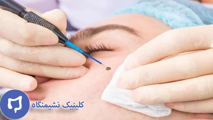 عکس درمان زگیل صورت با لیزر