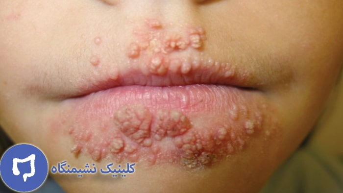 عکس زگیل صورت در اطراف دهان
