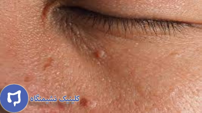 عکس زگیل صورت در نواحی گونه و بینی