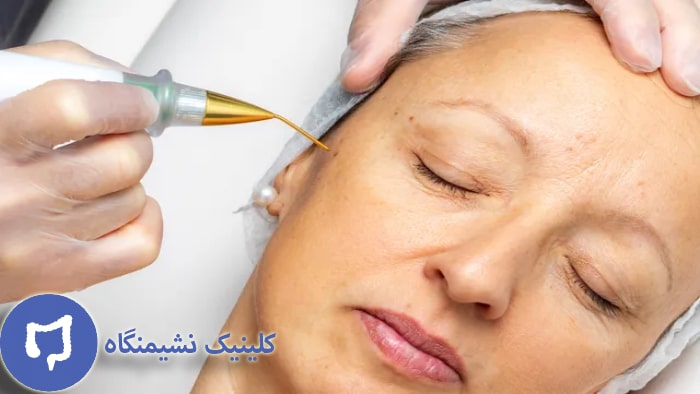 عکس لیزر زگیل صورت