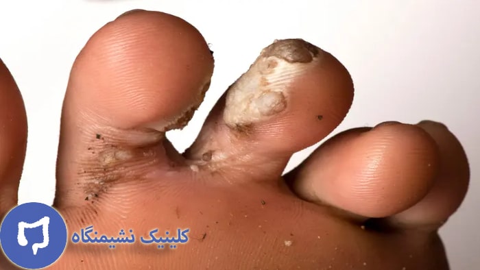 عکس زگیل انگشت پا