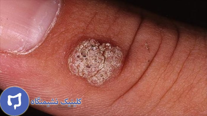 عکس از زگیل انگشت دست
