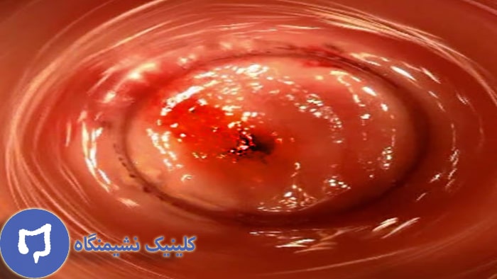 عکس آنوسکوپی شقاق مقعد