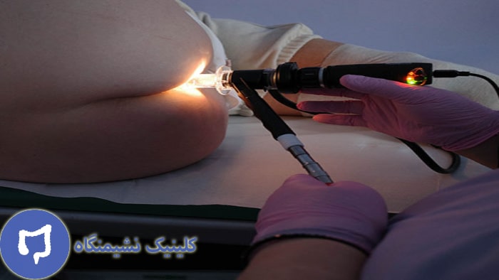 عکس لیزر شقاق مقعد