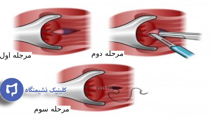 عکس جراحی شقاق مقعد