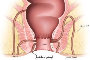 تصویر فیستول مقعدی