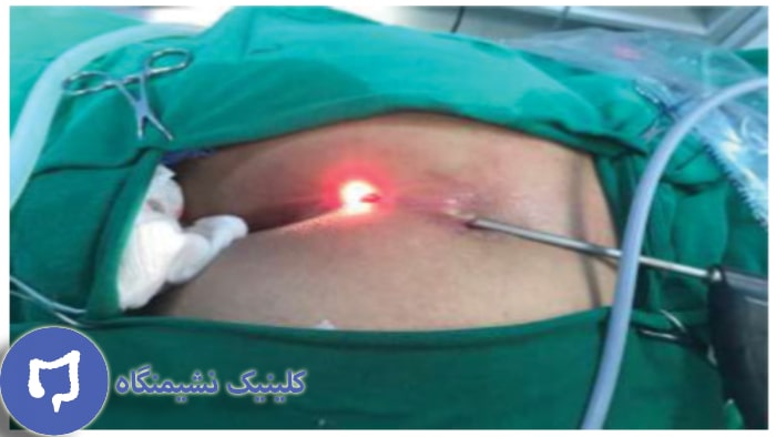 عکس لیزر فیستول