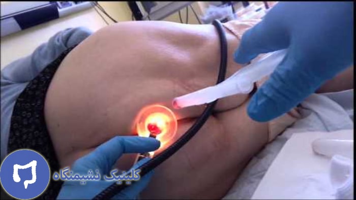 عکس درمان لیزری فیستول