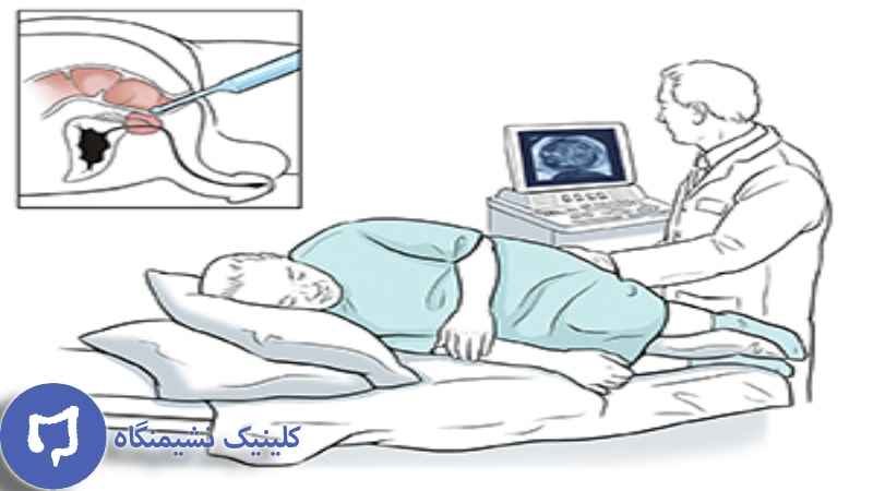 عکس تشخیص آبسه و فیستول مقعدی