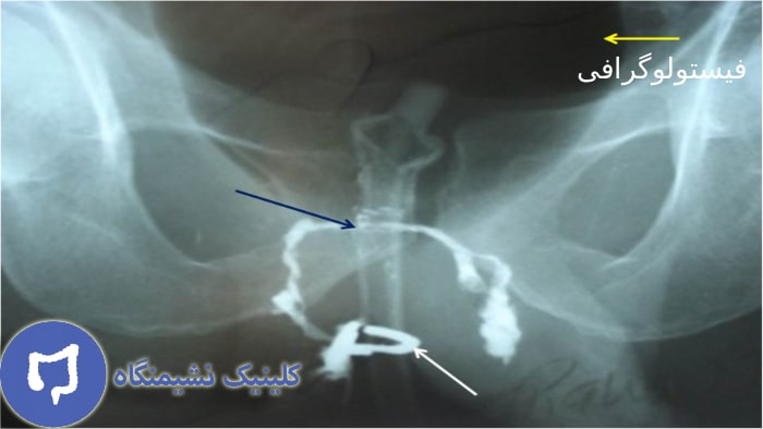 عکس فیستولوگرافی