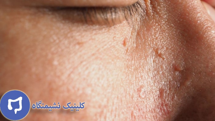 تصویر زگیل صورت