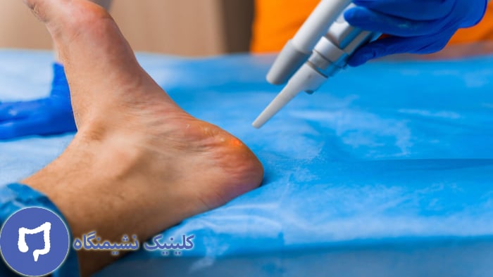 عکس لیزر زگیل پا