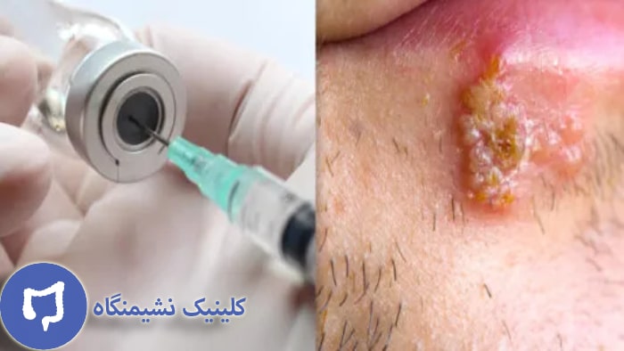 عکس واکسن گارداسیل