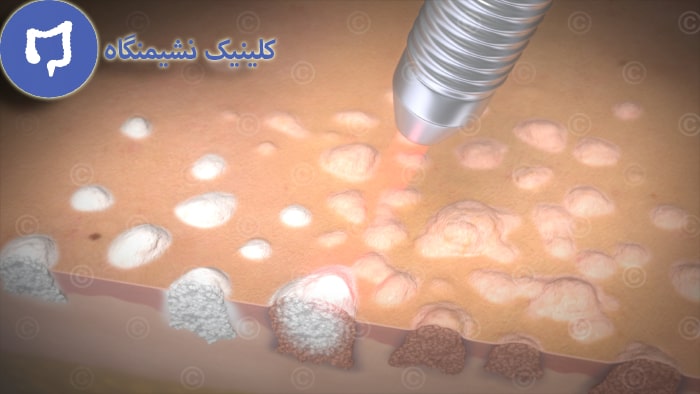 عکس درمان زگیل تناسلی با لیزر