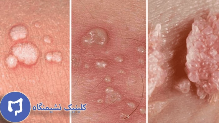عکس زگیل تناسلی چیست