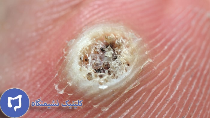 عکس درمان زگیل تناسلی با واجبی