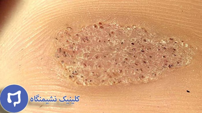 عکس زگیل تناسلی و تاثیر درمان خانگی