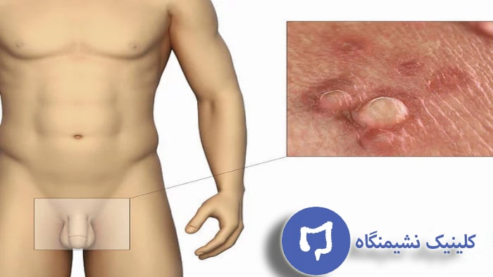 عکس بیماری زگیل تناسلی