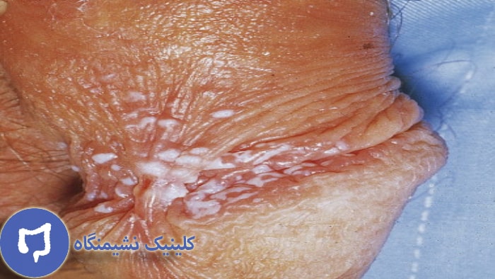 عکس زگیل تناسلی مردانه