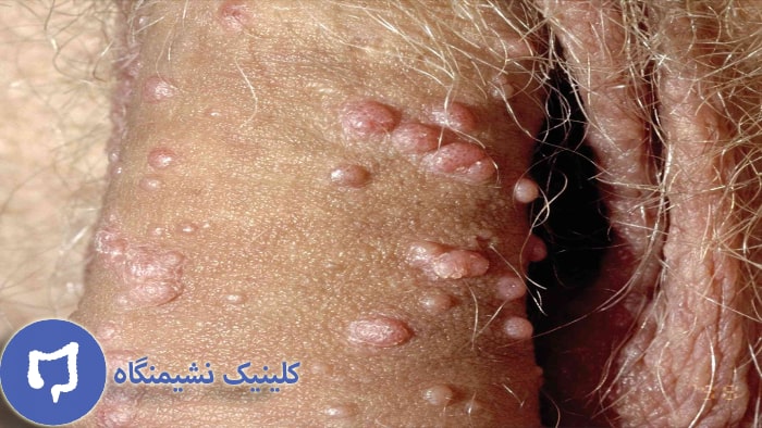 عکس زگیل تناسلی مردان